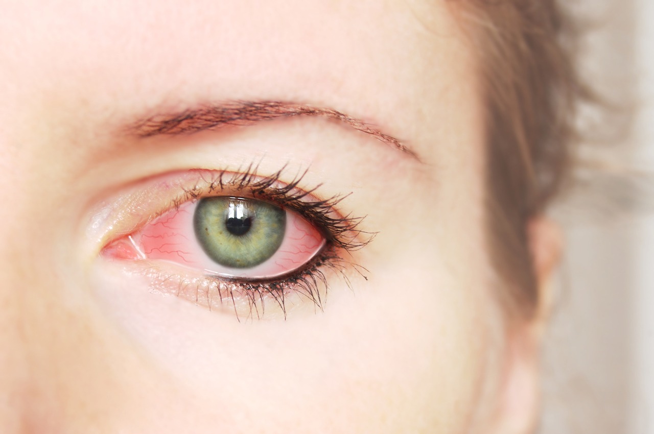 L'irritation des yeux est un des symptômes de la rosacée